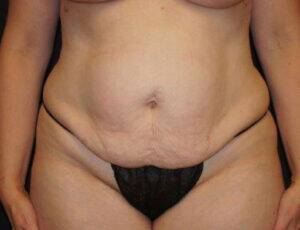 Tummy Tuck Case 5380 Before Photo Tummy Tuck