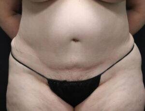 Tummy Tuck Case 5380 After Photo Tummy Tuck